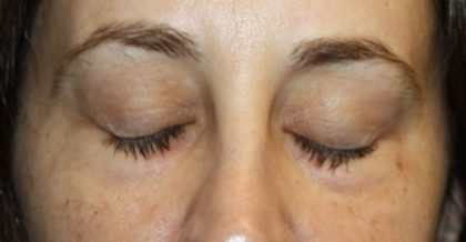 Blepharoplasty Before & After Patient #24834