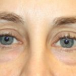 Blepharoplasty Before & After Patient #24834