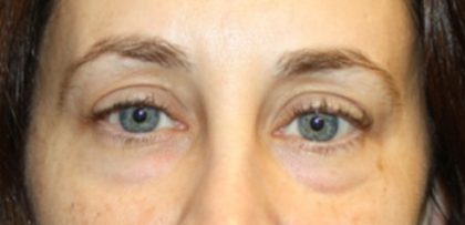 Blepharoplasty Before & After Patient #24834