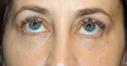 Blepharoplasty Before & After Patient #24834