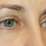 Blepharoplasty Before & After Patient #24834