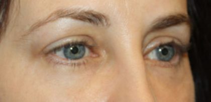 Blepharoplasty Before & After Patient #24834