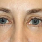 Blepharoplasty Before & After Patient #24834