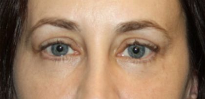 Blepharoplasty Before & After Patient #24834