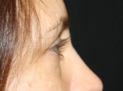 Blepharoplasty Before & After Patient #24834