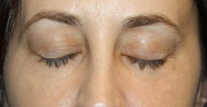 Blepharoplasty Before & After Patient #24834