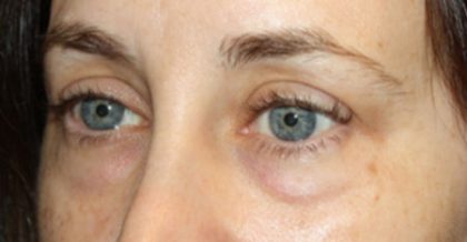 Blepharoplasty Before & After Patient #24834