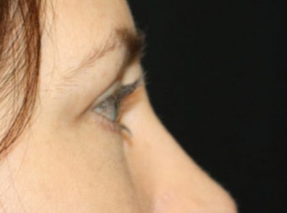 Blepharoplasty Before & After Patient #24834