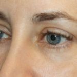 Blepharoplasty Before & After Patient #24834