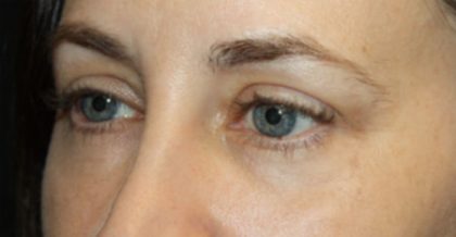 Blepharoplasty Before & After Patient #24834