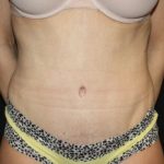 Tummy Tuck Before & After Patient #22893