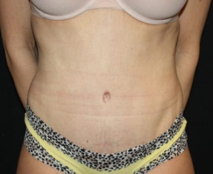 Tummy Tuck Before & After Patient #22893