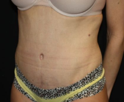 Tummy Tuck Before & After Patient #22893