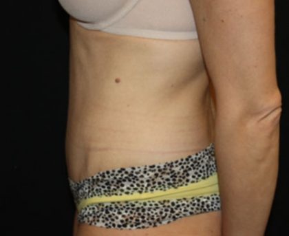 Tummy Tuck Before & After Patient #22893