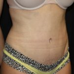 Tummy Tuck Before & After Patient #22893