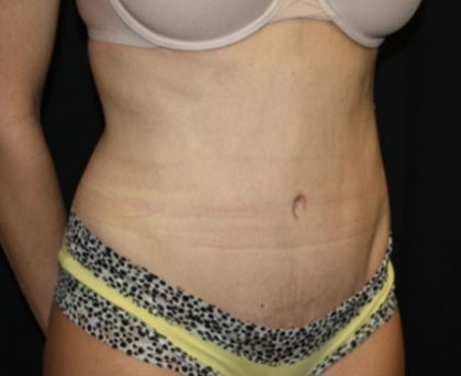 Tummy Tuck Before & After Patient #22893