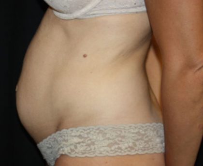 Tummy Tuck Before & After Patient #22893