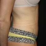 Tummy Tuck Before & After Patient #22893