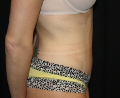 Tummy Tuck Before & After Patient #22893