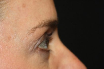 Blepharoplasty Before & After Patient #24859