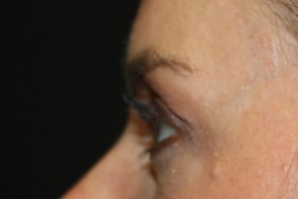 Blepharoplasty Before & After Patient #24859