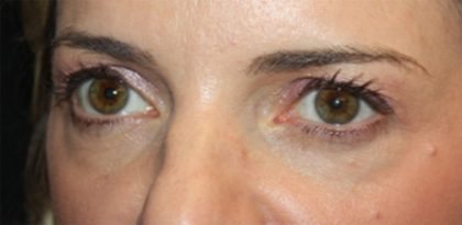 Blepharoplasty Before & After Patient #24859