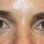 Blepharoplasty Before & After Patient #24859