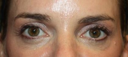 Blepharoplasty Before & After Patient #24859