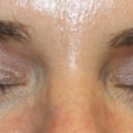 Blepharoplasty Before & After Patient #24859