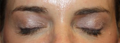 Blepharoplasty Before & After Patient #24859