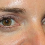 Blepharoplasty Before & After Patient #24859