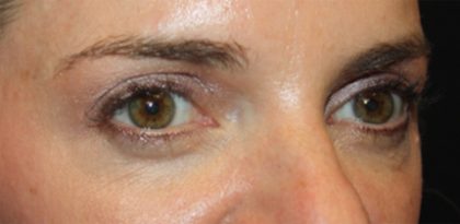 Blepharoplasty Before & After Patient #24859