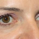 Blepharoplasty Before & After Patient #24859