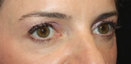 Blepharoplasty Before & After Patient #24859