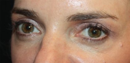 Blepharoplasty Before & After Patient #24859