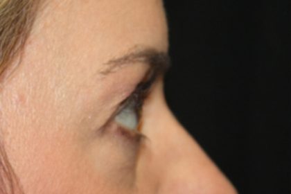 Blepharoplasty Before & After Patient #24859