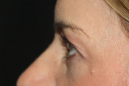 Blepharoplasty Before & After Patient #24859