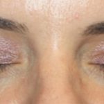 Blepharoplasty Before & After Patient #24859