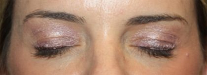 Blepharoplasty Before & After Patient #24859