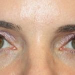 Blepharoplasty Before & After Patient #24859