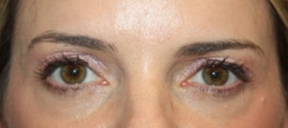 Blepharoplasty Before & After Patient #24859