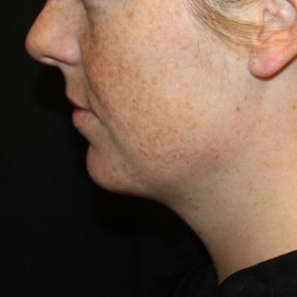 Kybella Before & After Patient #19814
