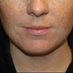 Kybella Before & After Patient #19814