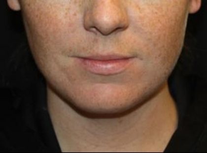 Kybella Before & After Patient #19814