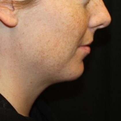 Kybella Before & After Patient #19814