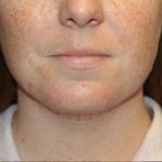 Kybella Before & After Patient #19814