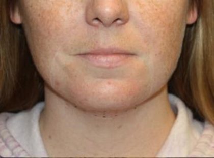 Kybella Before & After Patient #19814