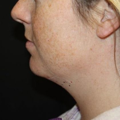 Kybella Before & After Patient #19814