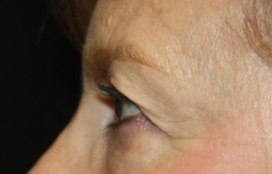 Blepharoplasty Before & After Patient #24966