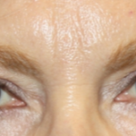 Blepharoplasty Before & After Patient #24966